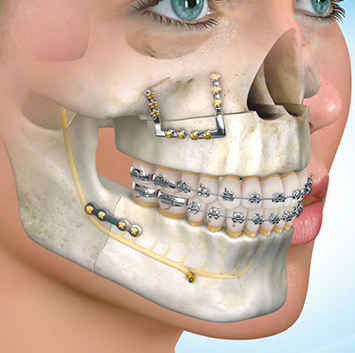 orthognatic surgery, oral and maxillofacial surgery, corrective jaw surgery, bio maxillar surgery, costa rica dental clinic